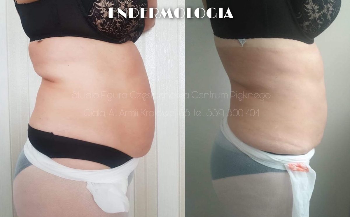Endermologia Częstochowa – efekty przed i po: brzuch i talia