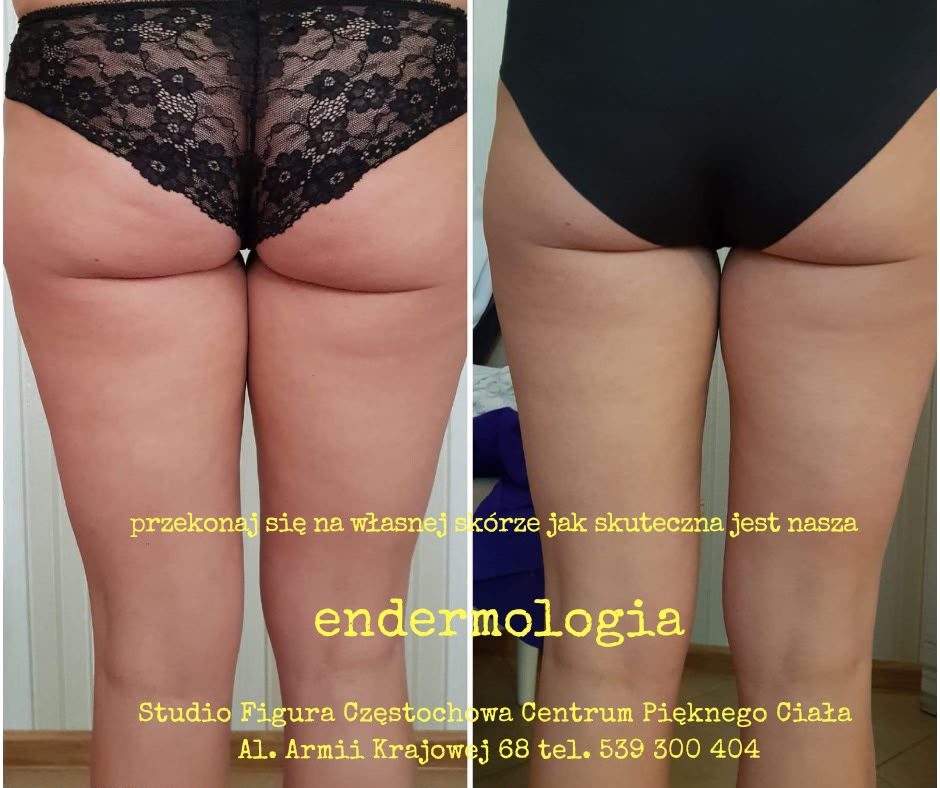 Endermologia Częstochowa – efekty przed i po: uda i pośladki