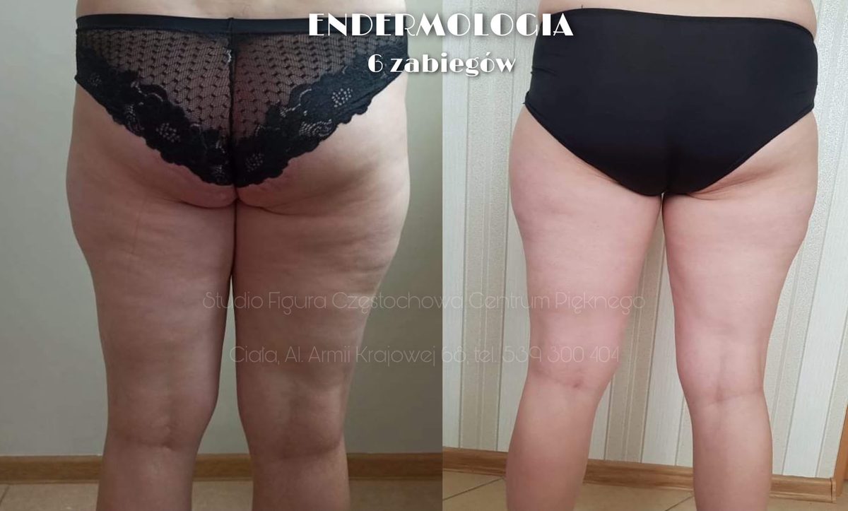 Endermologia Częstochowa – efekty przed i po 6 zabiegach: uda i pośladki