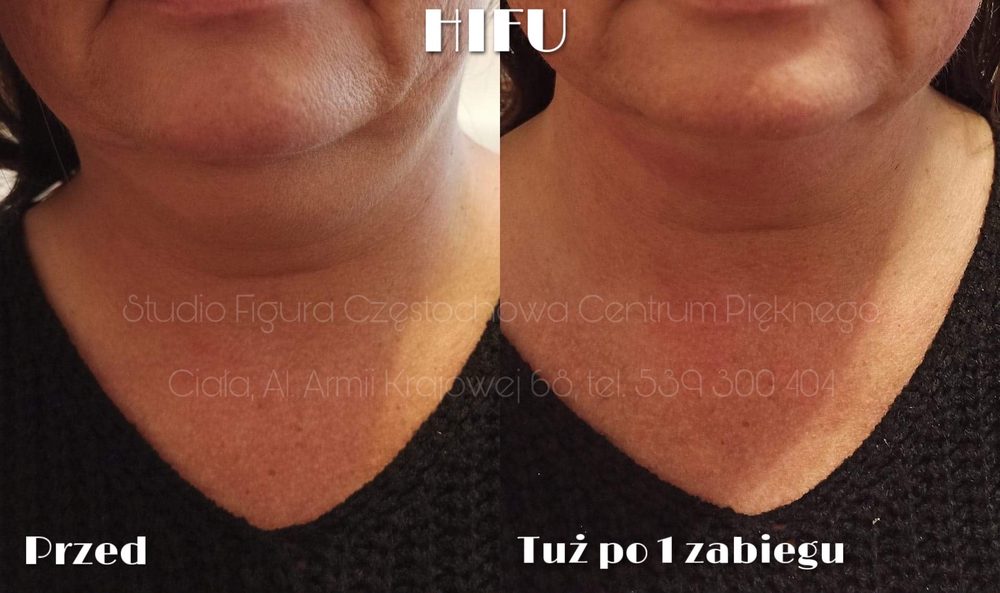 HIFU Częstochowa – szyja i podbródek przed i tuż po 1 zabiegu