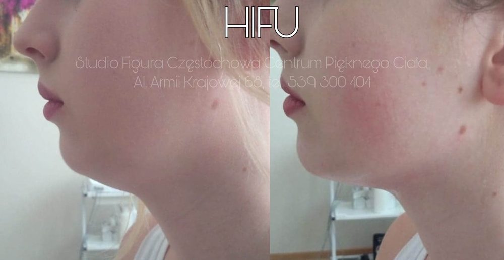 HIFU Częstochowa – linia żuchwy i podbródek przed i po zabiegu
